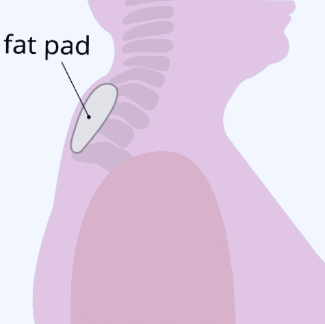 buffalo hump neck showing fat pad