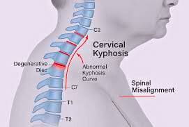 Dowager's neck hump showing hyperkyphosis